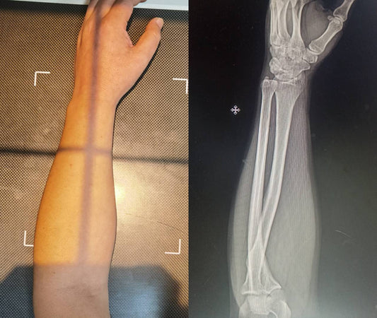 An actual medical X-ray of a human forearm in the same vertical mouse position, revealing that the radius and ulna bones are still crossed, labeled 'Anatomical Reality.' This visual evidence refutes the claim that vertical mice uncross forearm bones.